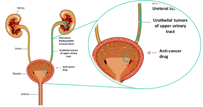 frontiers-targeting-urothelial-tumors-of-upper-urinary-tract-with